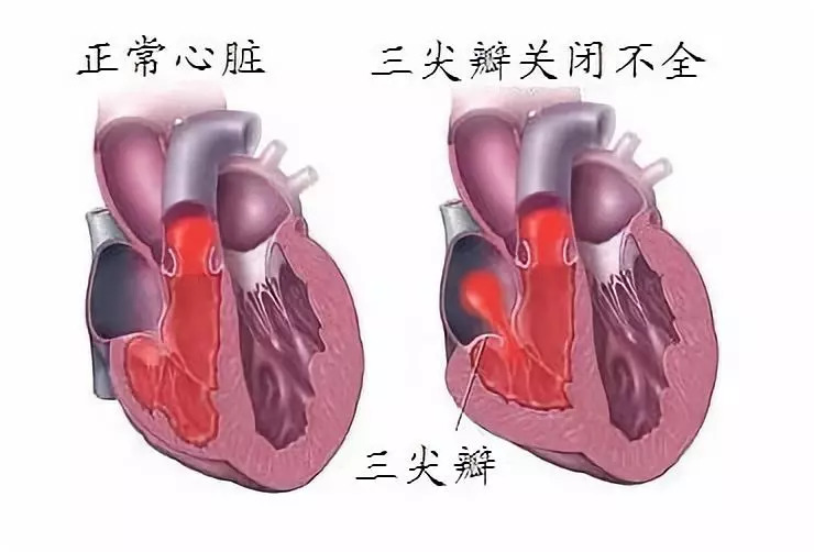 吉林市首例】心脏不停跳房间隔缺损修补,三尖瓣修复(三尖瓣环成形术)